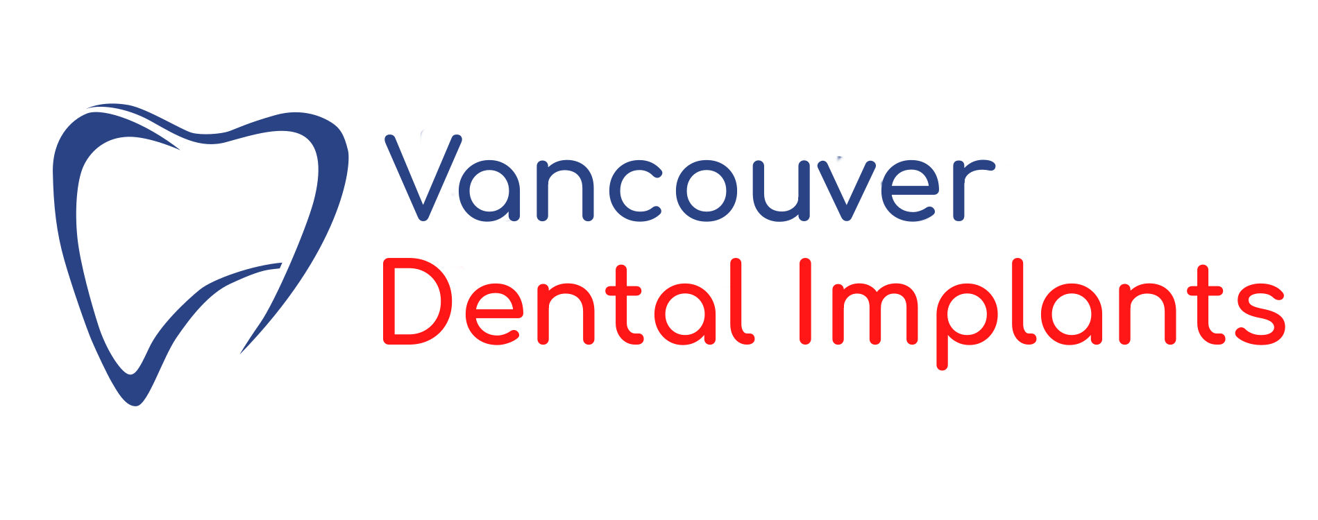 Dental Implants in Vancouver